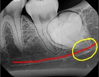 Teeth X-Ray