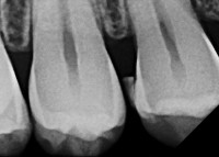 Teeth X-Ray