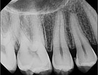 Teeth X-Ray